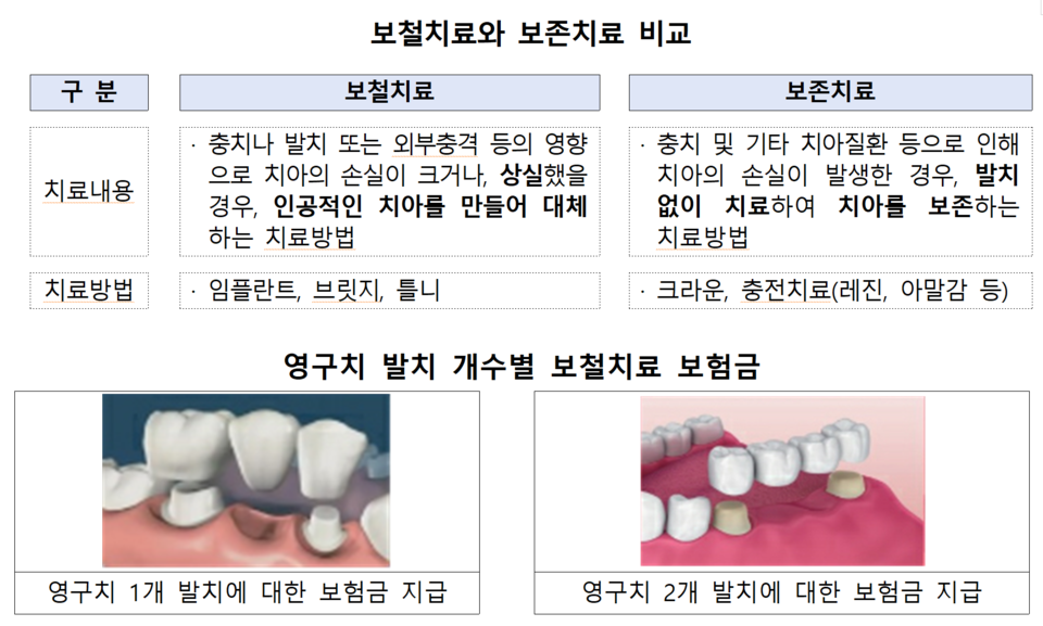 브리지와 임플란트 보험금은 영구치 발치 개수에 따라 산정돼 주의가 필요하다. /자료=금융감독원