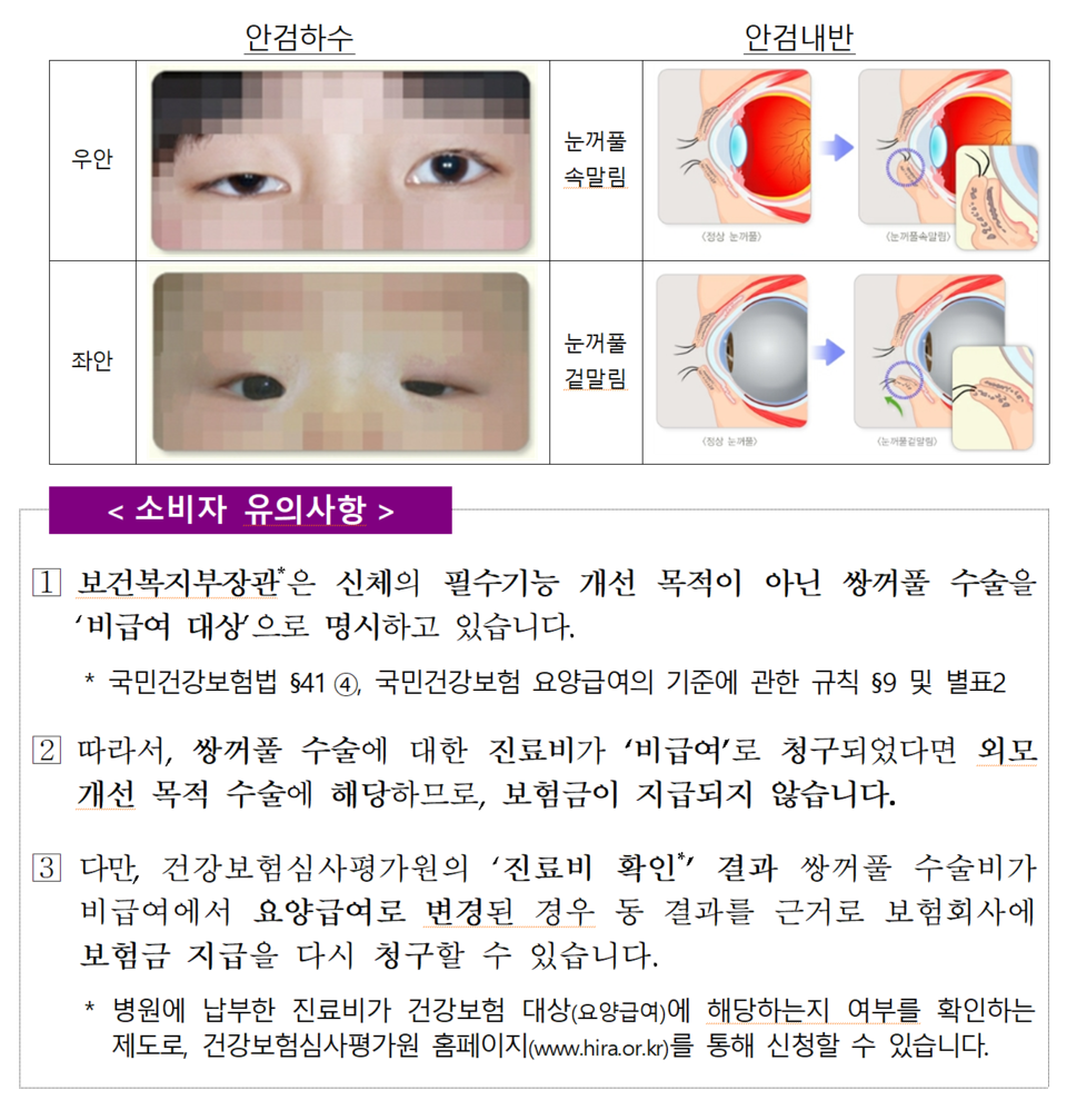 쌍꺼풀 수술의 경우, 안검하수(눈꺼풀 처짐증)나 안검내반(눈꺼풀이 말려 들어가 속눈썹이 눈을 자극하는 증상) 등이 아니면 건강보험 비급여처럼 실손보험금도 받을 수 없다. /자료=금융감독원