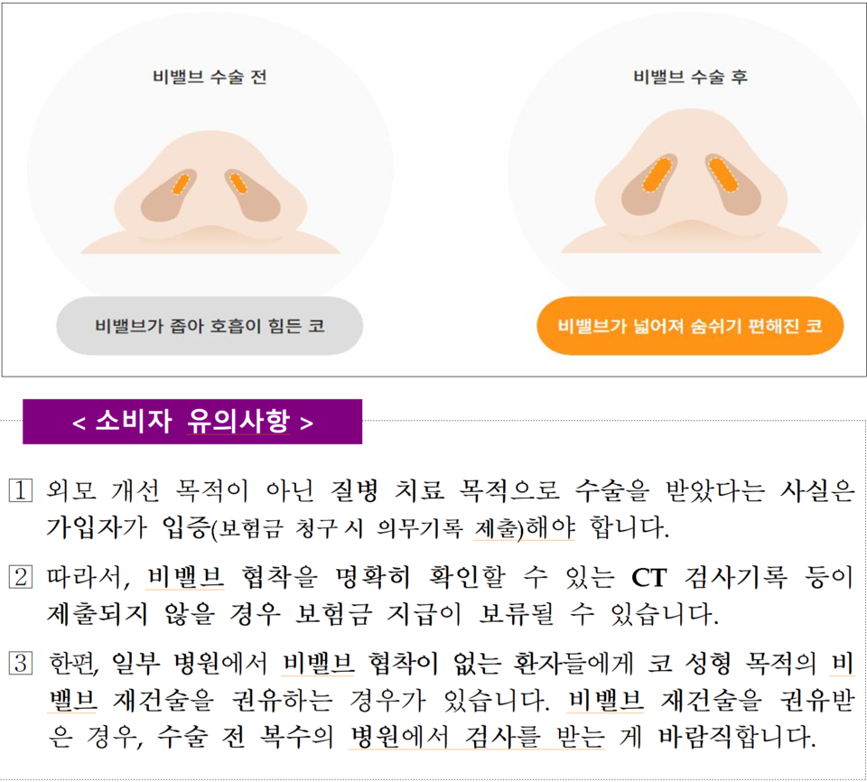코막힘 치료로 시행하지만, 성형 효과까지 있는 ‘비밸브 재건술’도 CT 검사기록 등을 제출해야 보험금을 받을 수 있다. /자료=금융감독원